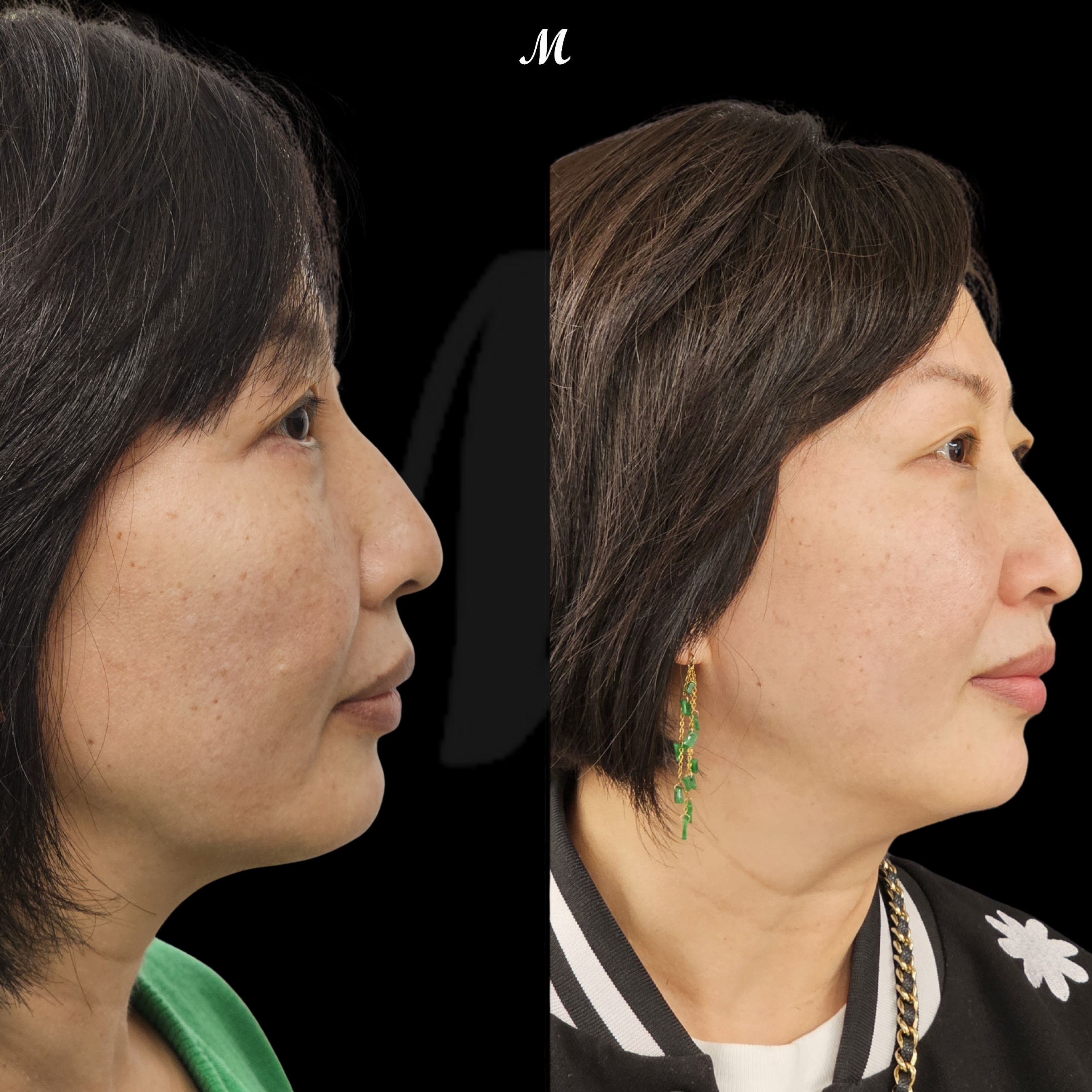 Defined 3D Thread Lift